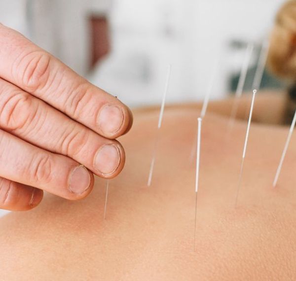 acupuncture
