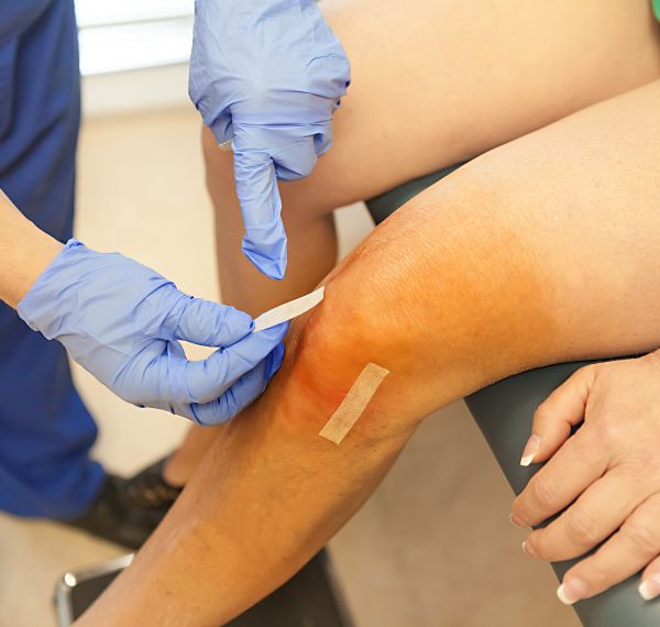 arthroscopic acl reconstruction