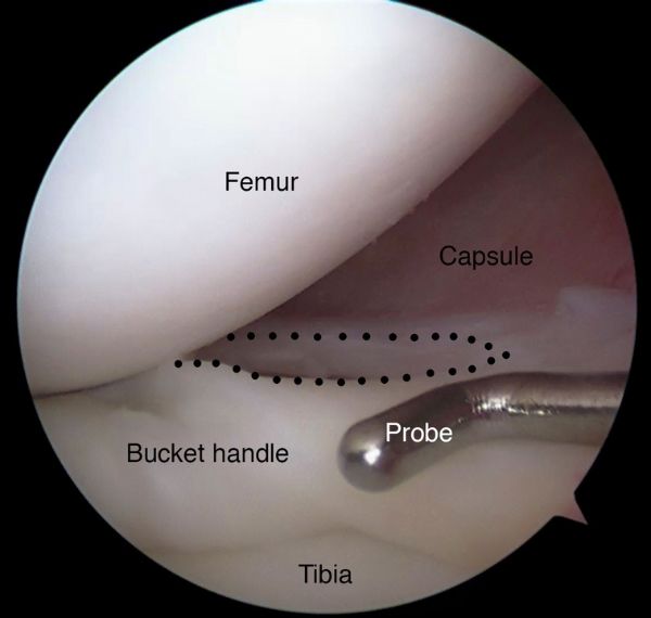 arthroscopic meniscus repair