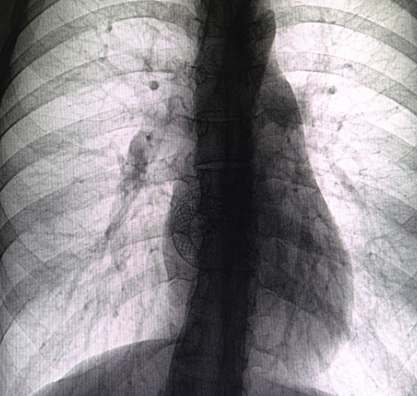 atrial septal defect asd closure
