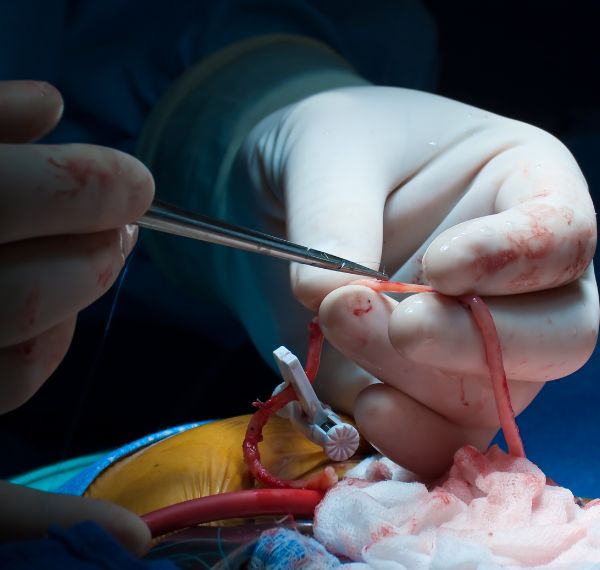 cardiac bypass with off pump technique