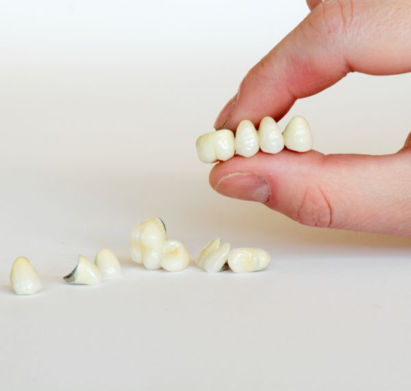 dental crowns and bridges