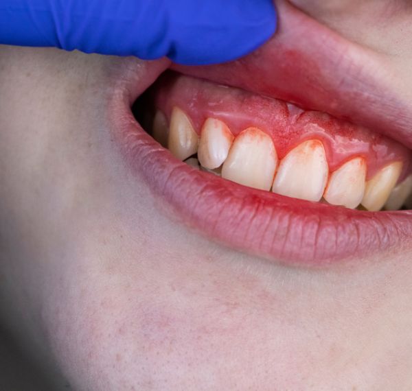 gum disease treatment periodontics