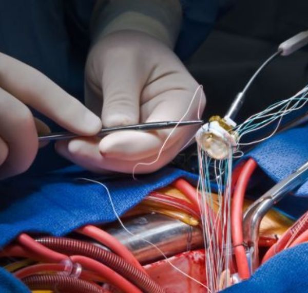 heart valve replacement