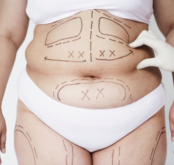 liposuction
