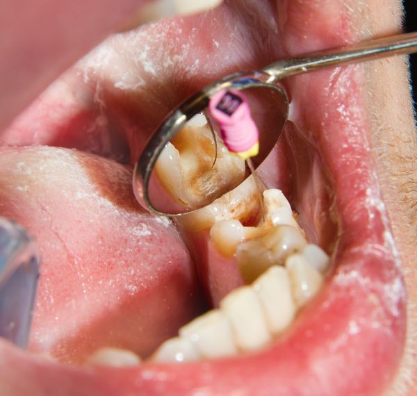 root canal treatment