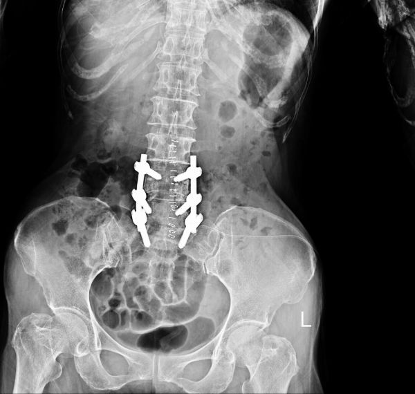 spine surgery discectomy laminectomy