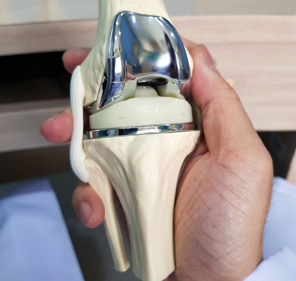 total knee replacement tkr