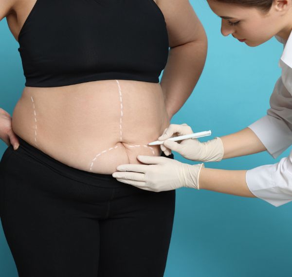 tummy tuck abdominoplasty